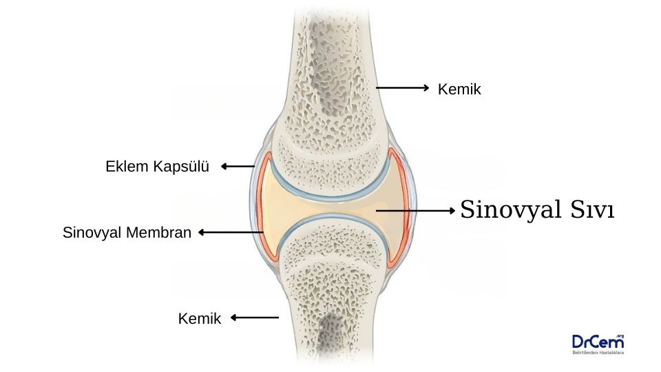 Sinovyal Effüzyon görseli - DrCem hastalık rehberi